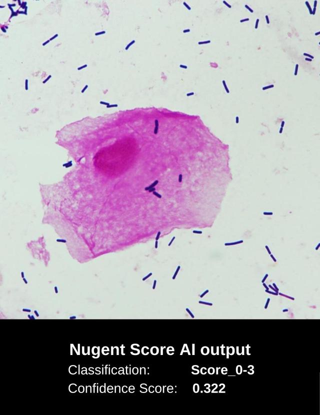 Analyzed Nugent Score Image