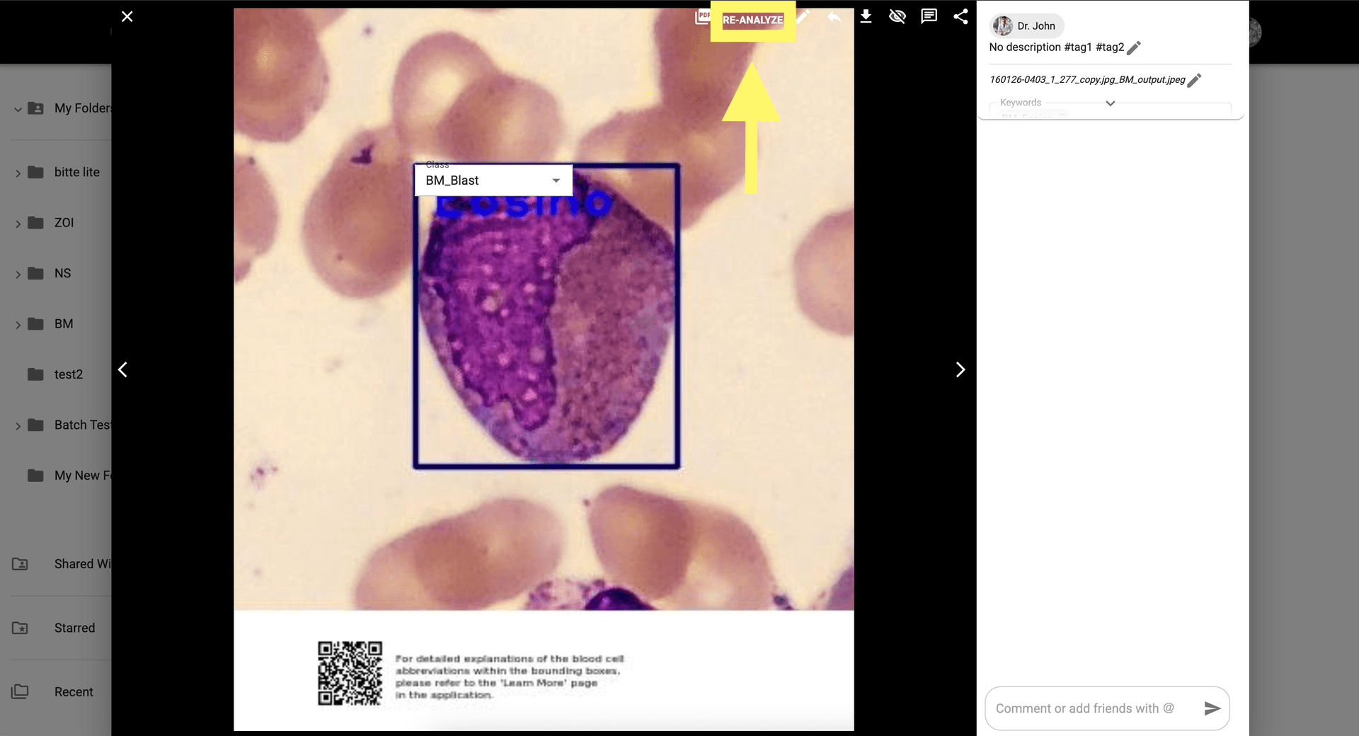 Step 8 image about How to use BM Smear AI 1.0 tutorial Step 8: Click 'Re-Analyze' to apply any manual changes to your bone marrow smear analysis.