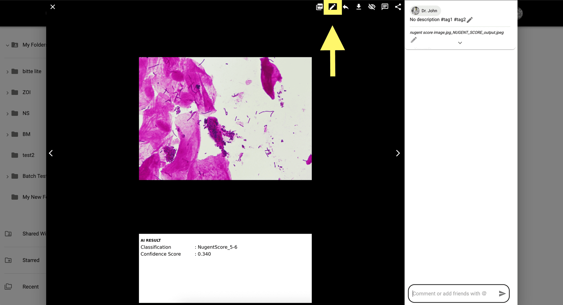 Step 6 image about How to use Nugent Score AI 1.0 tutorial Step 6: For manual corrections, select 'Show AI correction' at the top-right of the image modal.