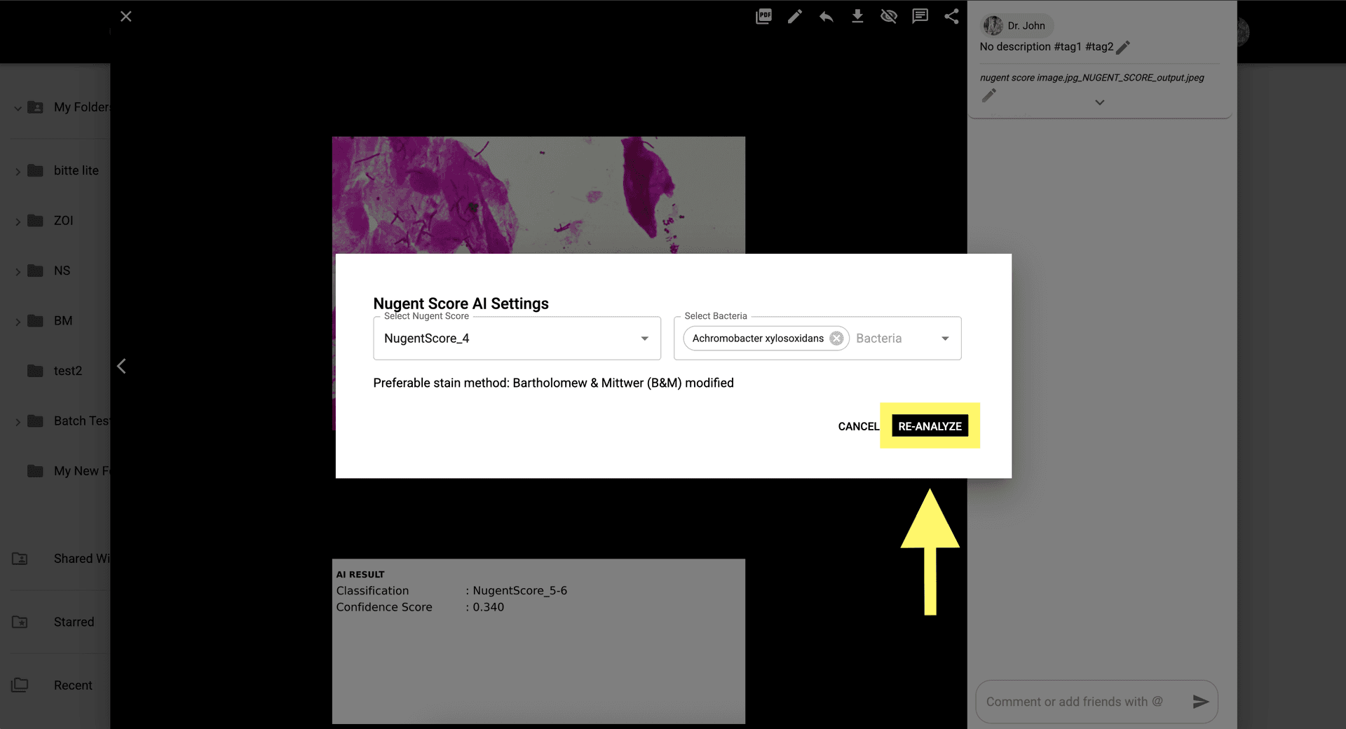 Step 8 image about How to use Nugent Score AI 1.0 tutorial Step 8: Click 'Re-Analyze' to save any manual changes and update the final score.